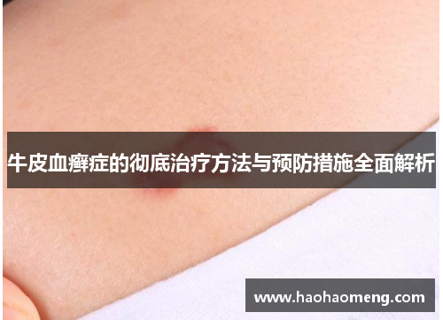 牛皮血癣症的彻底治疗方法与预防措施全面解析 牛皮血癣症的彻底治疗方法与预防措施全面解析
